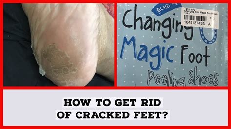 Changin magic foot peeling shoes